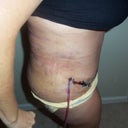 Post op day 4...side view, with hunching!