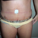 Post op, day 4 front view, very swollen, one drain my right side.