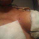The day after surgery Bandages removed, breast numb
