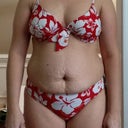 Before Mommy Makeover Pic 1