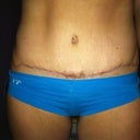 Scare at 5 1/2 months post op