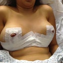day 1 right after the surgery