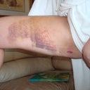 burn on inner thigh