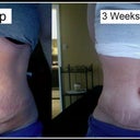 3 Weeks Post Op Tummy tuck Before and After Front