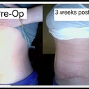 3 Weeks Post Op Tummy tuck Before and After Side