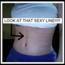 Sexy Line 3 Weeks Post Op tummy tuck