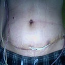 3 Days Post Op tummy tuck