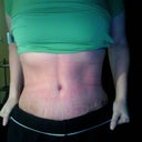 Ab Definition 4 Weeks Post Op tummy tuck