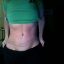 Incision @ 4 Weeks Post Op tummy tuck