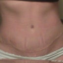 4 weeks 1 Day Post Op tummy tuck - At Night No Swelling