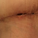 Close up of TT incision that split. Looking MUCH better, it has finally scabbed over and started to heal.