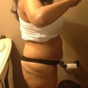 This photo taken BEFORE LIPO OF THE UPPER AND LOWER ABDOMIN