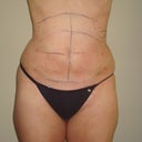 This is one day after the procedure