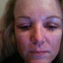 2 weeks after surgery