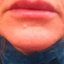 Day 7 - Devastated by size of top lip, she shape & unsure if overfilled or still swollen :(