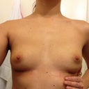 Post-op day 3