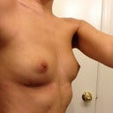 Post-op side view day 3