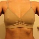 Post-op with little bra day 3