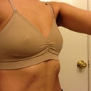 Post-op side view with little bra day 3