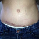Weird belly button, crooked scar, indented deep stretch marks, hello pubes.