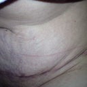 What a tummy tuck scar really looks like when sitting down up close. How has no one posted a picture like this? As the first consultation dr said "it loosens up"  It does no matter how tight.know this