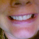 Lumineers are in, but gums and teeth not shaped yet