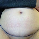 My surgeon's practice marks for my incision!