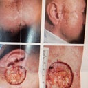 Before & After Moh's surgery.