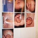 Before & after Moh's surgery