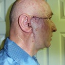 Day of reconstructive surgery