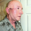 Several days after reconstructive surgery