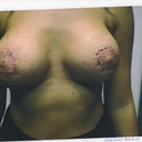 Healing after 1st revision