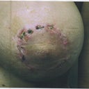 Healing process after main procedure in 2011