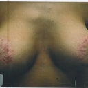 Scarring and result after implants and nipple lift