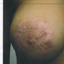 Scarring after main procedure