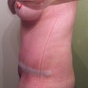 Day 21-Woke up feeling flatter. Still bruised on flanks from lipo and still swollen below bb-little back fat