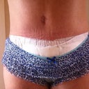 week four still swollen on hips from lipo, and still bandaged due to having to have six stitches put in