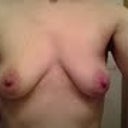 front view pre-op