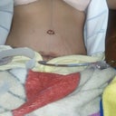 One day post-op