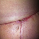 Under right 19 days post op! starting to look better!