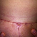 Under left 19 days post op! I think sleeping with no bra on for a night helped get the wounds some AIR!