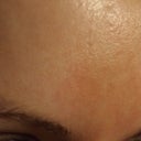 DAY 16 - forehead.  This is the area with the worst track lines, hyper pigmentation, and you can also see the texture which is kind of like an orange peel.  Hope with how proactive I am being now in light of this, I will be able to post a new photo in a few weeks showing this healed and filled in.