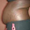 side view before surgery