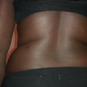 back view before srugery