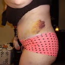Day 5 Post Op....VERY swollen.  bruising from lipo