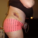 Day 5 Post Op....VERY swollen.  bruising from lipo