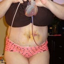 Day 5 Post Op....VERY swollen.  bruising from lipo around belly button