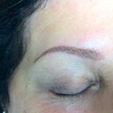 She took the picture directly after the procedure. They got much lighter after a few days.
