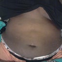 day after 2nd procedure