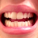 Prior to Treatment